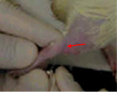 <ul><li><p><span><span>The saphenous veins are large, subcutaneous, superficial veins of the hindlimbs.</span></span></p></li><li><p><span><span>Two effective approaches depend on comfort for the RVT. This is either using the medial (inner) or lateral (outer) vein. Two people may be required to achieve this procedure in rats. Always apply pressure until the bleeding has stopped.</span></span></p></li><li><p><span><span>After appropriate restraint, apply a silicone-based gel (e.g., Vaseline) on the skin to prevent blood from mixing with fur. Shaving or plucking is not required.</span></span></p></li><li><p><span><span>For the medial venous site, gently extend the outer hindlimb (closest to your baby finger) with your dominant hand and position your restraint hand over the vein with gentle pressure using one to two fingers over the inguinal area; this prevents the animal from pulling back its leg.</span></span></p></li></ul><ul><li><p><span><span>For the lateral venous site, it is recommended to restrain using the “burrito” method if non-anesthetized. Extend the hindlimb out of the towel. Hold off the vein with gentle pressure using your fingers of the restraint hand over the inguinal area; this prevents the animal from pulling back its leg.</span></span></p></li><li><p><span><span>Using a needle bevel up, puncture the vein at a 45 to 90° angle until the needle tip is just through the skin (the vessel is quite shallow). A bleb of blood should appear after removing the needle. Lighten up pressure over inguinal area to promote blood flow.</span></span></p></li><li><p><span><span>Collect blood sample with a Microvette or capillary tube by placing tip close to the bleb using gravity and angle downward. If blood slows or stops, gently wipe area with gauze to disturb the clot formation or softly pump the limb back and forth to increase outflow. Apply pressure until the bleeding has stopped.</span></span></p></li></ul><p></p>