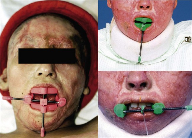 <p>- apply stretch to tissues surrounding the oral cavity while permitting speech</p>
<p>- to prevent contracture of lip and buccal tissues </p>