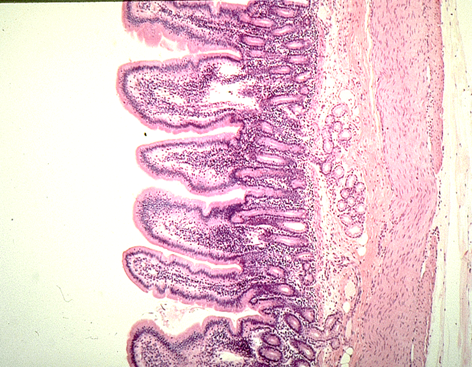 <p><strong>Diffuse lymphatics</strong></p><p><em>A concentration of purple dots observed</em></p>