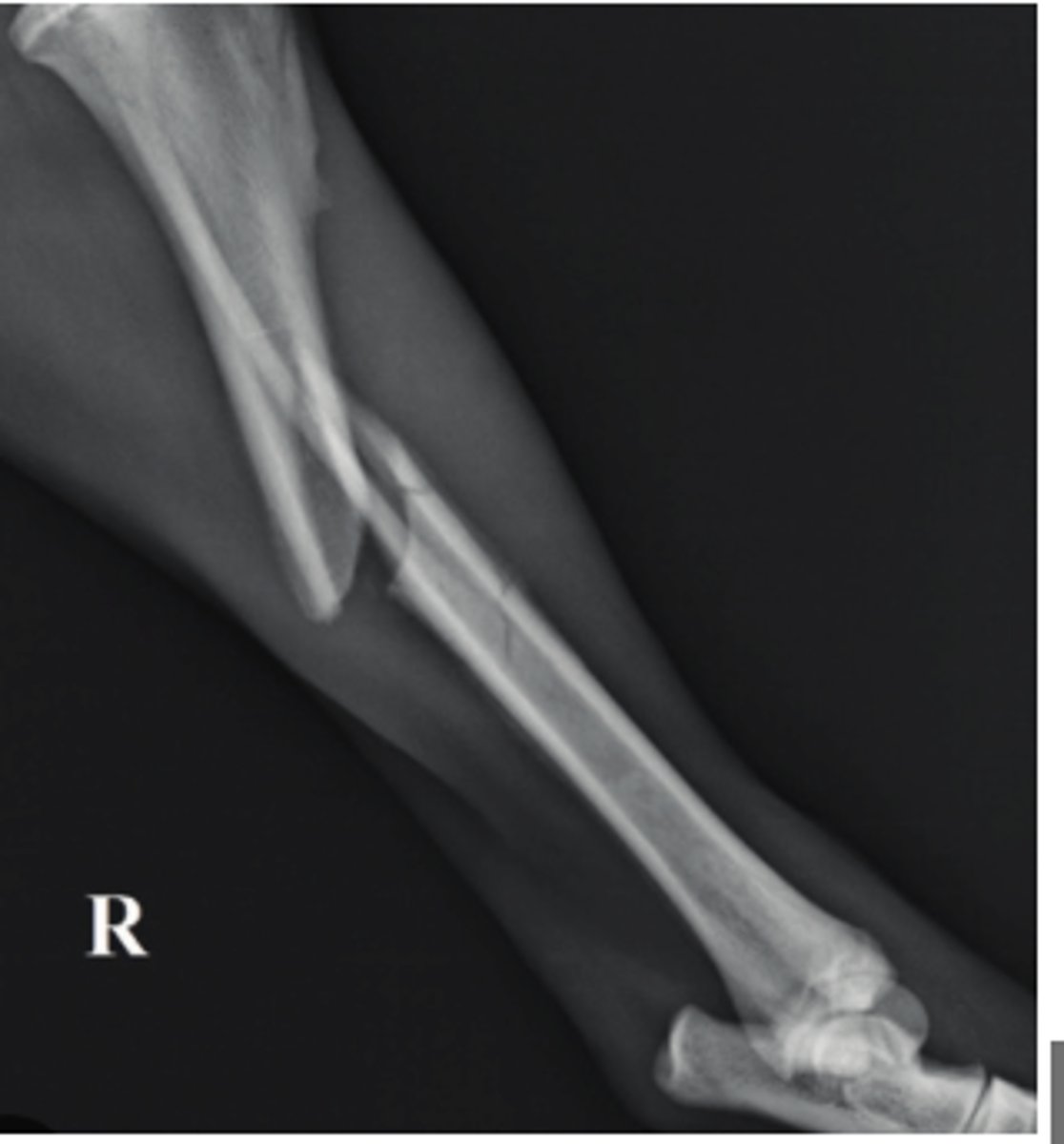 <p>What describes this bone fracture</p>
