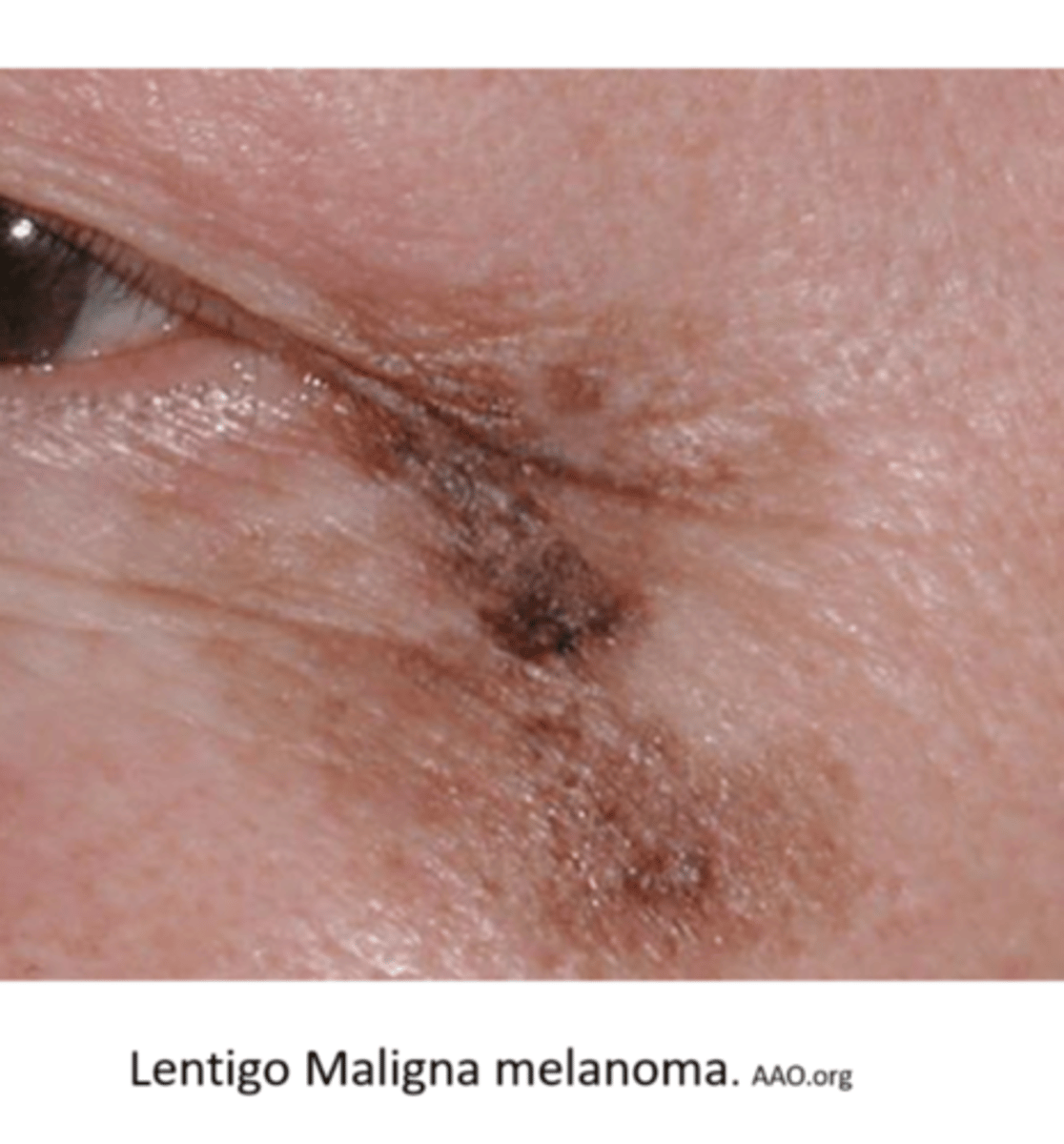 <p>from variable "stain-like" lentigo maligna that invades neighbouring tissues</p>