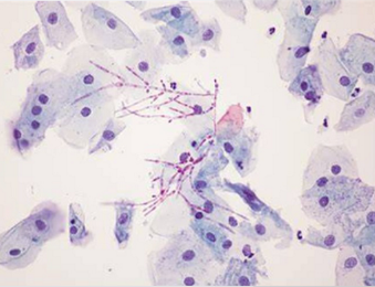 <p>what is vaginal candidiasis?</p>