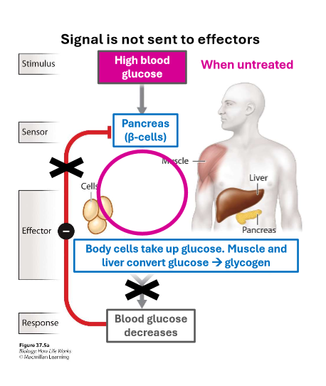 <p>this is caused by autoimmune destruction of beta cells in the pancreas, hence signal to uptake glucose is not sent to effectors</p>