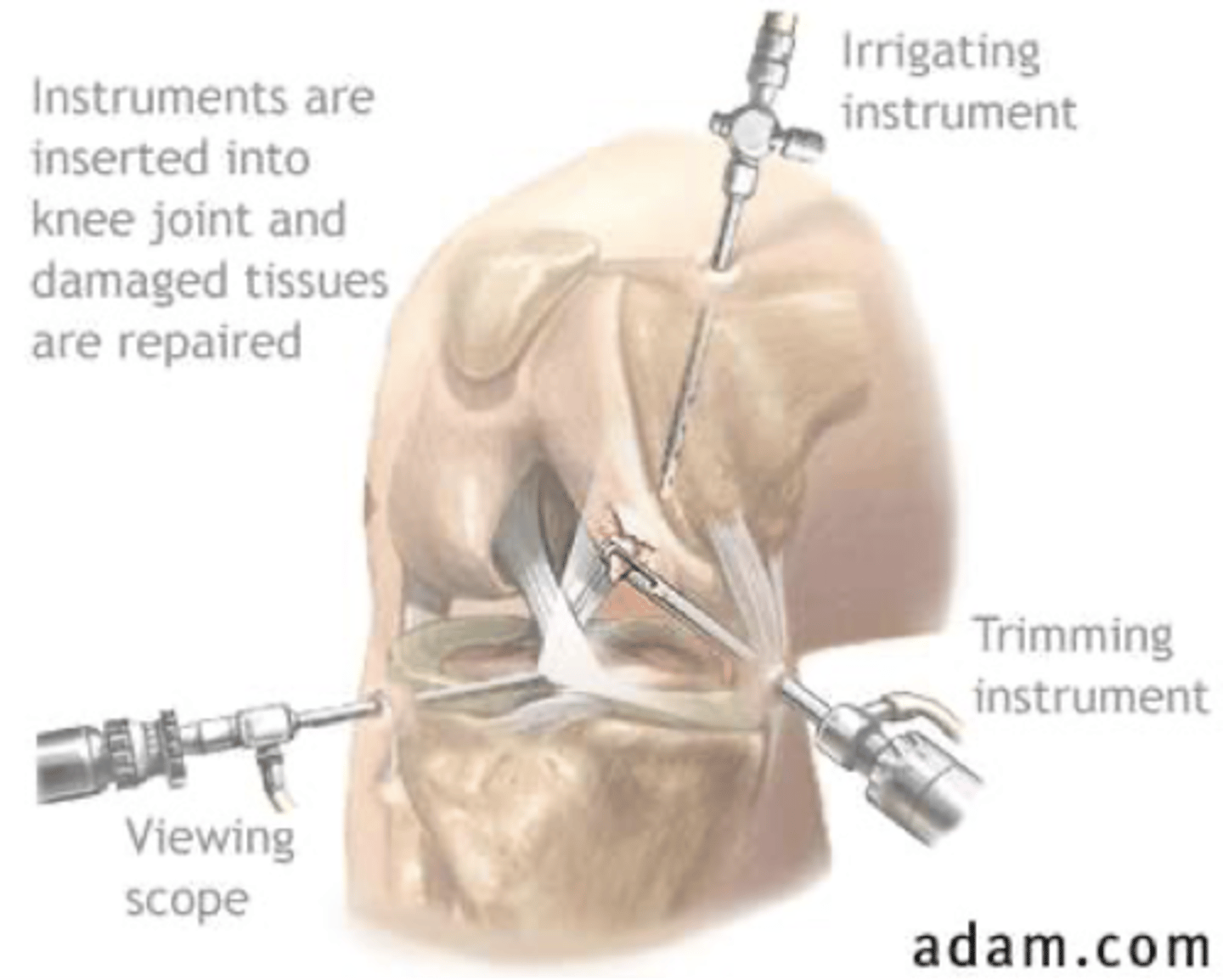 <p>arthroscopic debridement or repair</p>