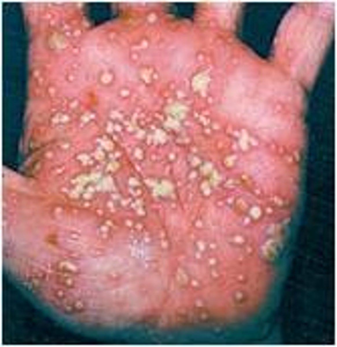 <p>Pustular psoriasis</p>