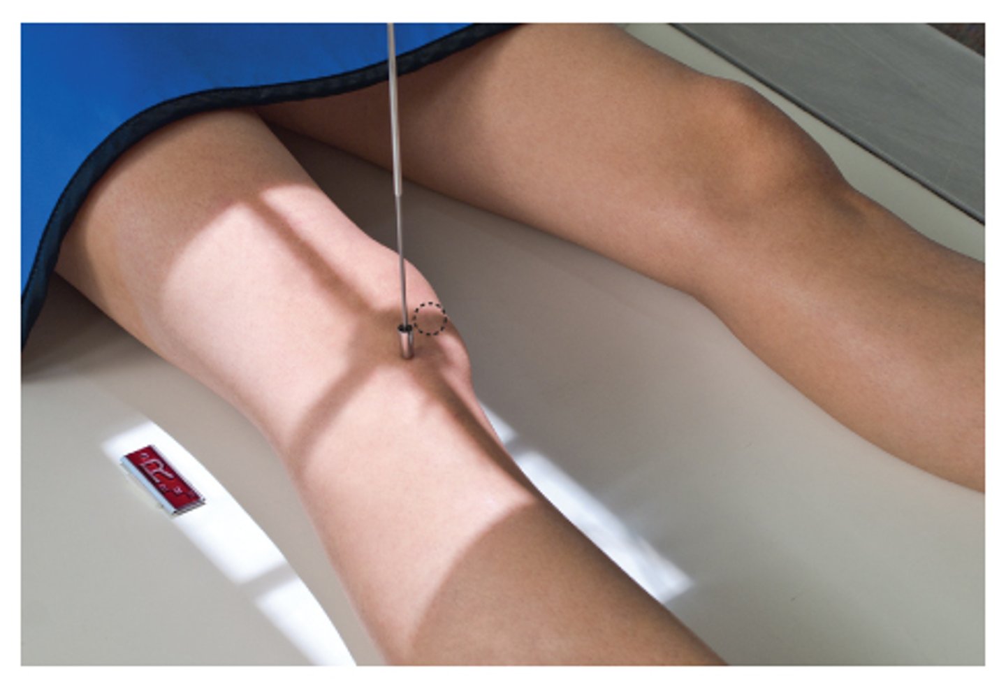 <p>rotate entire leg internally 45 degrees (interepicondylar 45 degrees to plane of IR)</p>