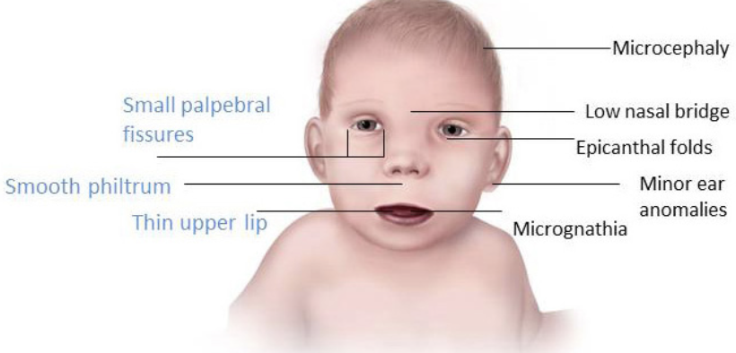 <p>→ serious condition associated with alcohol consumption during the 3rd/4th week of pregnancy causing certain facial anomalies and severe intellectual disabilities for the fetus </p><ul><li><p>Babies born to alcoholic mothers are typically smaller than average and fall behind in development</p></li></ul><p></p>