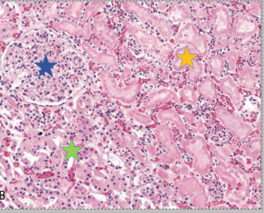 <p>Coagulative necrosis - basic outline of necrotic cells is preserved</p><ul><li><p>hypoxic injury - infarction</p></li></ul><p>Gross:</p><ul><li><p>well demarcated (infarction), rim of inflammation</p></li><li><p>Firmer and dryer</p></li></ul><p>Histo:</p><ul><li><p>preserved tissue architecture - basement membrane often intact</p></li><li><p>necrotic cells</p></li><li><p>inflammation</p></li><li><p>early attempts at healing</p></li></ul><p></p>