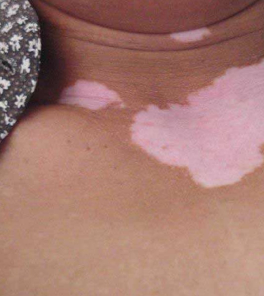 <p>¿lesión?</p><p>¿primaria o secundaria?</p>