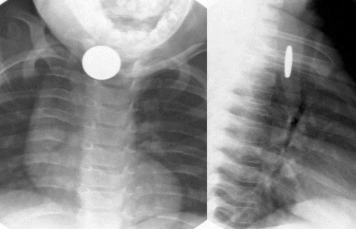 <p>You order a STN X-ray for a patient with a suspected foreign body. When you get the image back, the frontal view shows the face of the coin. The lateral view shows the side of the coin. Is the coin stuck in this patient's trachea or esophagus?</p>