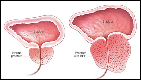 <p>give another example of pathological hyperplasia </p>