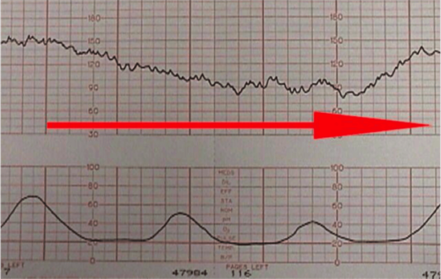 <p>adj extended = lengthened, protracted, sustained, drawn-out &gt;&lt; short, brief, fleeting, temporary kéo dài They undertake prolonged movements. /prəˈlɔːŋd/ prolonged exposure (sự phơi nhiễm kéo dài)</p>