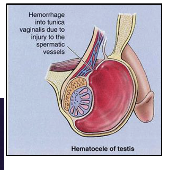 <ul><li><p>collection of blood in the <strong>tunica vaginalis</strong> caused by trauma to testes</p></li><li><p>more painful than a hydrocele</p></li></ul><p></p>