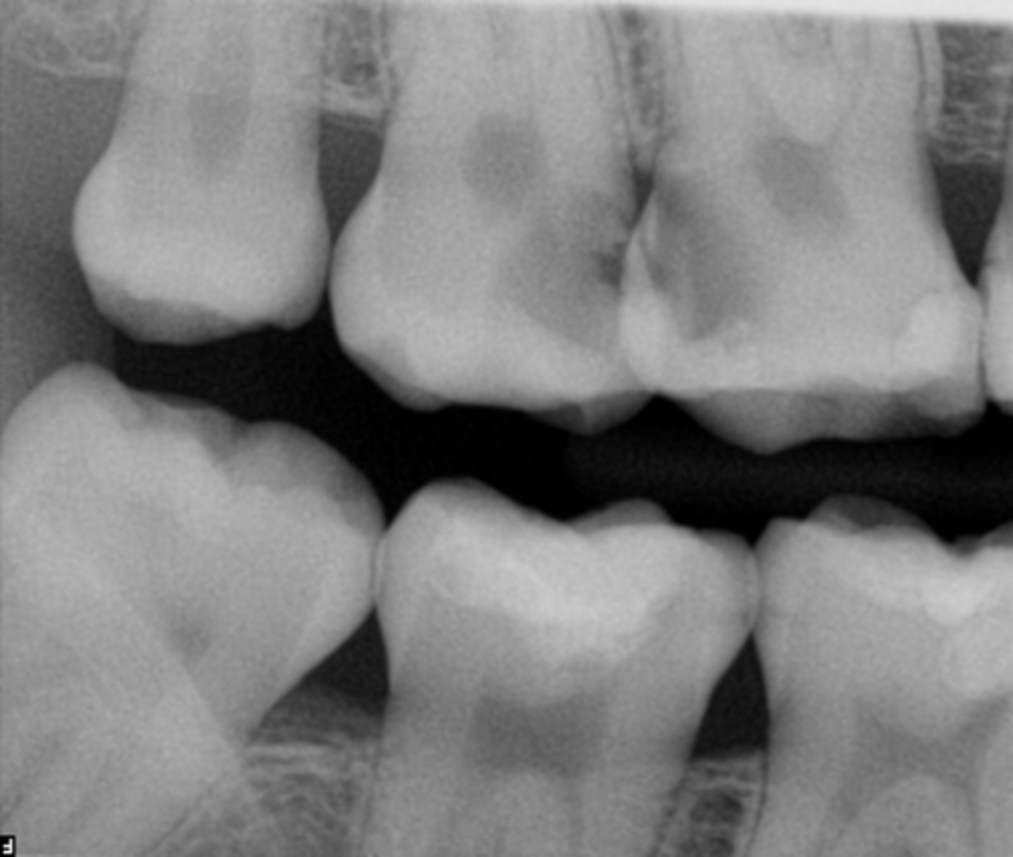 <p>ID the pulpal diagnosis:</p><p>- Patient reports no symptoms</p><p>- Cold test: Hypersensitive non lingering (2-3 sec)</p><p>- Radiograph shows very deep caries into the pulp chamber</p>