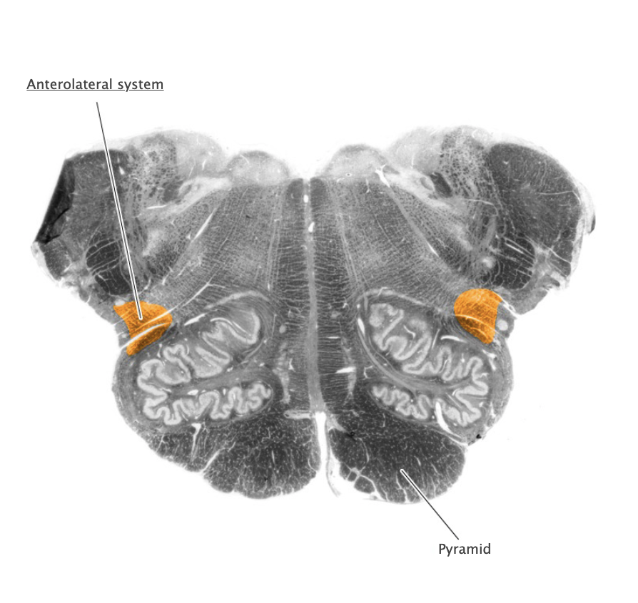<p>nerve pathway from the spine to the thalamus along which pain impulses are carried to the brain, major component of the anterolateral system</p>