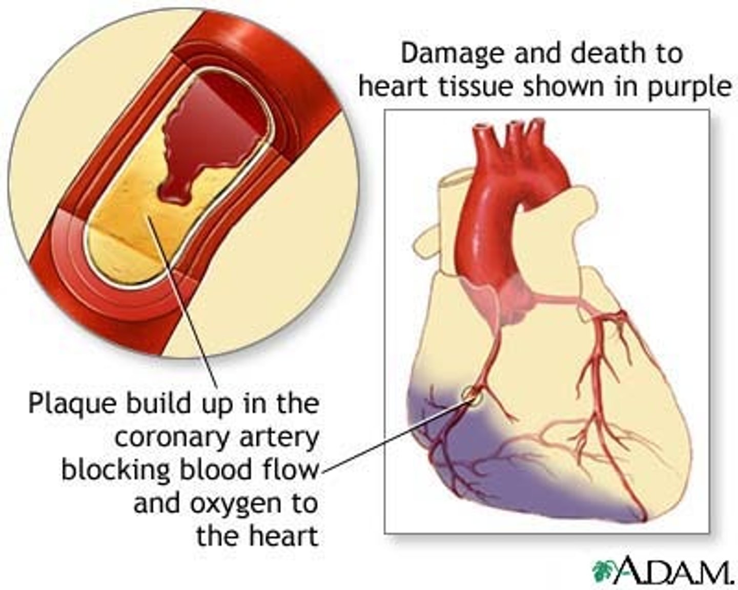 <p>-blockage of one or more coronary arteries</p><p>-heart muscles deprived of blood begin to die</p><p>if a substantial section of the heart is damaged, it will stop pumping AKA cardiac arrest</p>