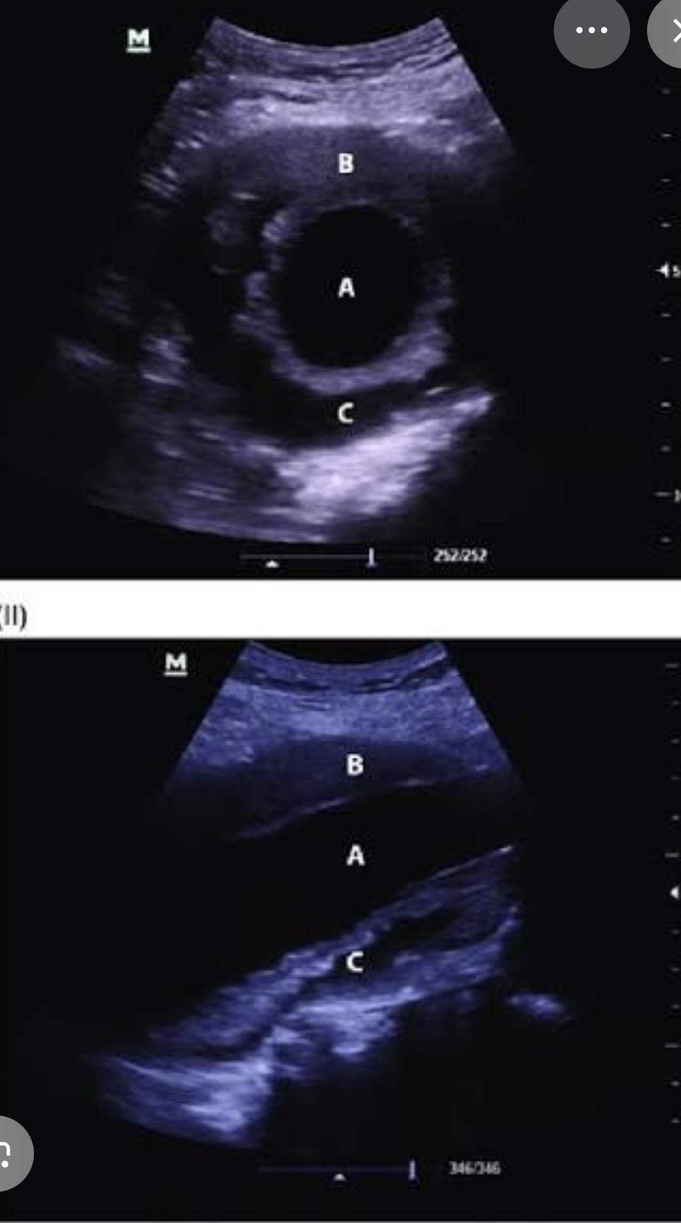 <p>69-year-old man seen for RUQ ultrasound for persistent pain. The ultrasound reveals cholelithiasis (gallstones) with free fluid around the GB consistent with cholelithiasis. Incidentally noted are findings in the aorta the aorta measured 6.6 cm in AP diameter. What is the likely diagnosis?</p>