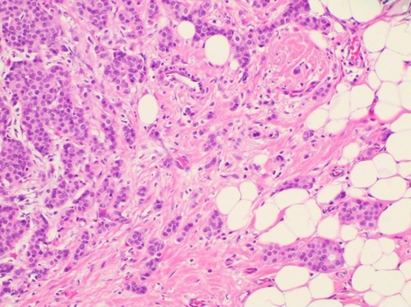 <p>Characterized by desmoplasia and ECM stiffening.</p>