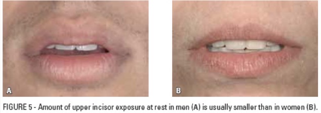 <p>1.91mm</p><p>3.40mm</p><p>Important factor in youthful smile </p>