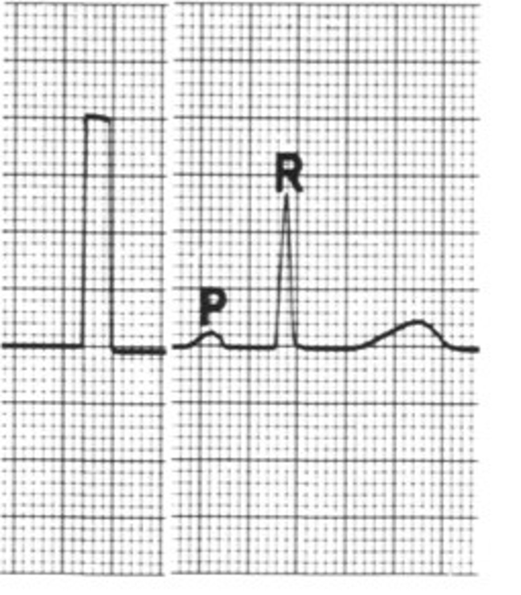 <p>What is the sensitivity of this if I tell you 2 cm = 1 mV</p>