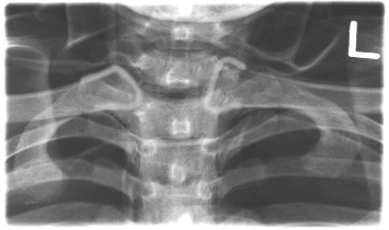 <p>PA erect or recumbent, arms at sides/overhead, no rotation or tilt, CR perpendicular at T3.</p>