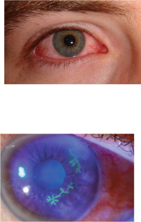 <p>pain, visual blurring, watery discharge, injection near limbus, dendrites on fluorescein stain on <strong>cornea</strong></p>