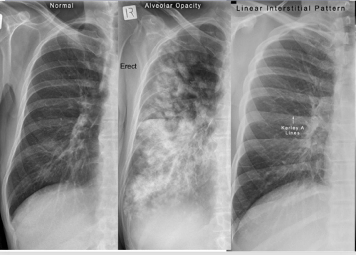<p>lung fibrosis</p>
