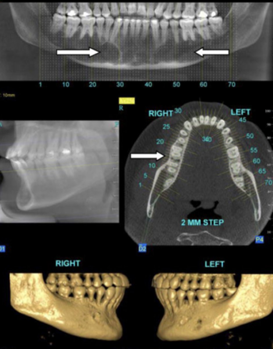 <p>-ill-defined radiolucencies of the jaws</p><p>-walls of mandibular canal may be obliterated</p><p>-decreased salivary flow</p><p>-increased bleeding tendency</p><p>-increased risk of post-op infection</p>