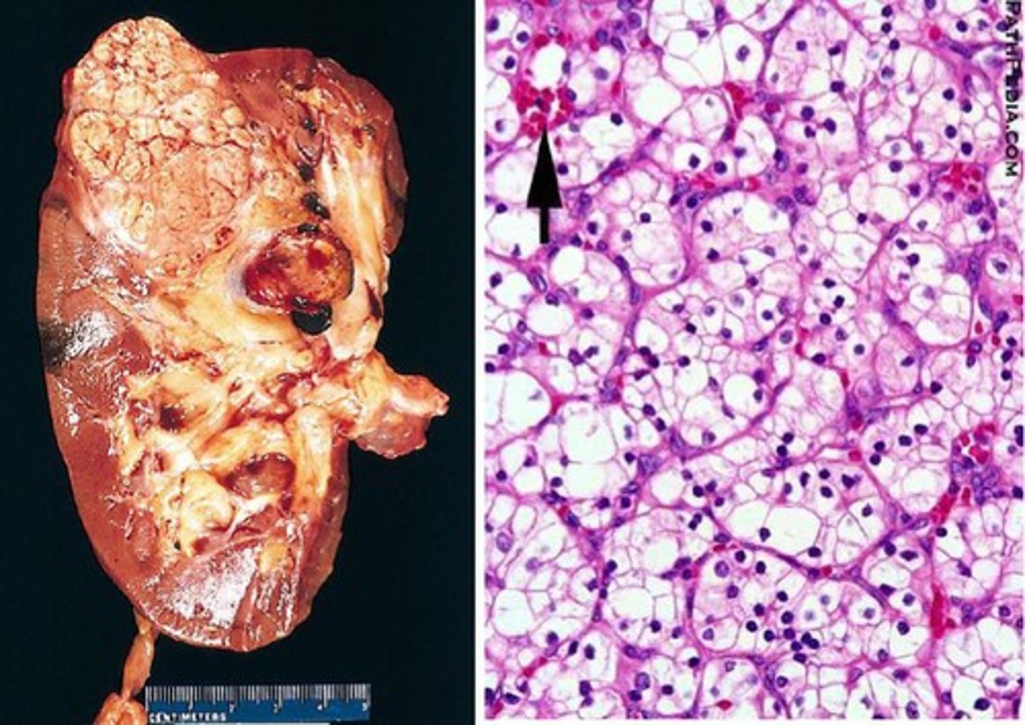 <p>Renal cell carcinoma (RCC)</p>