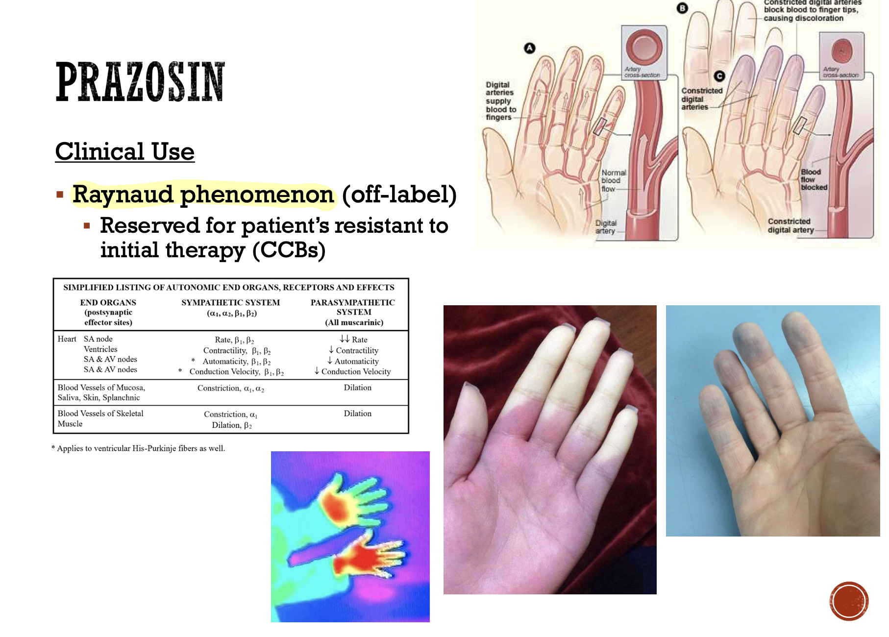 <p>Prototype of the selective α1- adrenergic blocking agents</p><p>for HTN</p><p>Used in combination with</p><p>diuretics, β-blockers or other</p><p>antihypertensive agents</p><p> Attractive drug for hypertensive</p><p>patients with BPH</p><p></p><p>Raynaud phenomenon (off-label)</p><p>PTSD-related nightmares and sleep disruption (off-label)</p><p> Likely by inhibition of central α1-receptors</p><p></p><p>ADR: Orthostatic hypotension with syncope, ECF retention, tachycardia</p>