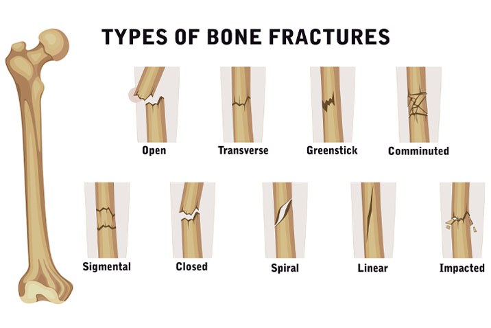 Common types of Bone Fractures
