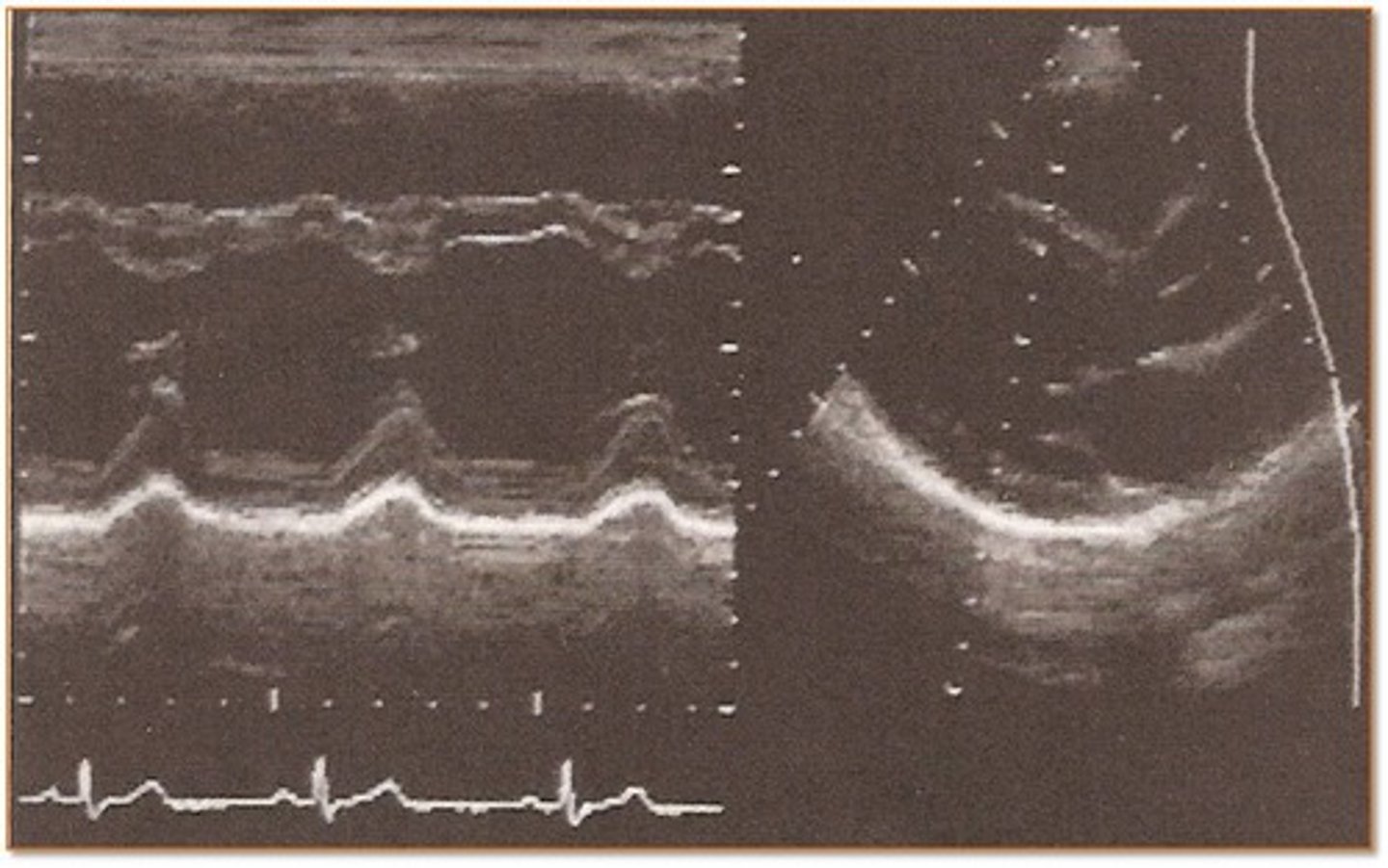 <p>M-mode illustrating heart wall motion and heart valve motion</p>