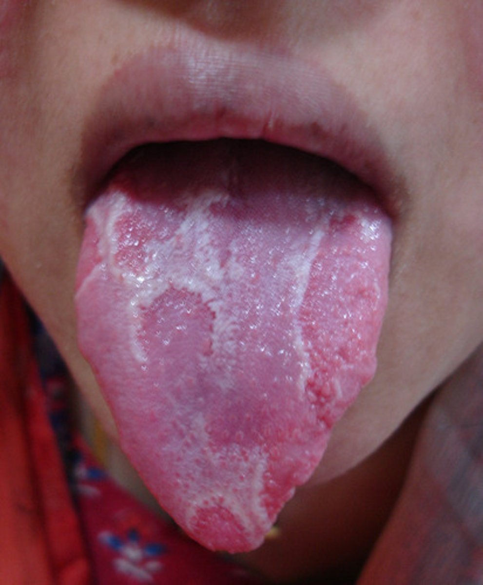 <p>Geographic tongue</p><p>• tender, red, atrophic center with prominent white (yellowish) scalloped border</p><p>• common locations: usually on dorsal tongue, also ventral tongue&amp; mucosa</p><p>• associated with stress</p><p>• moves around</p>