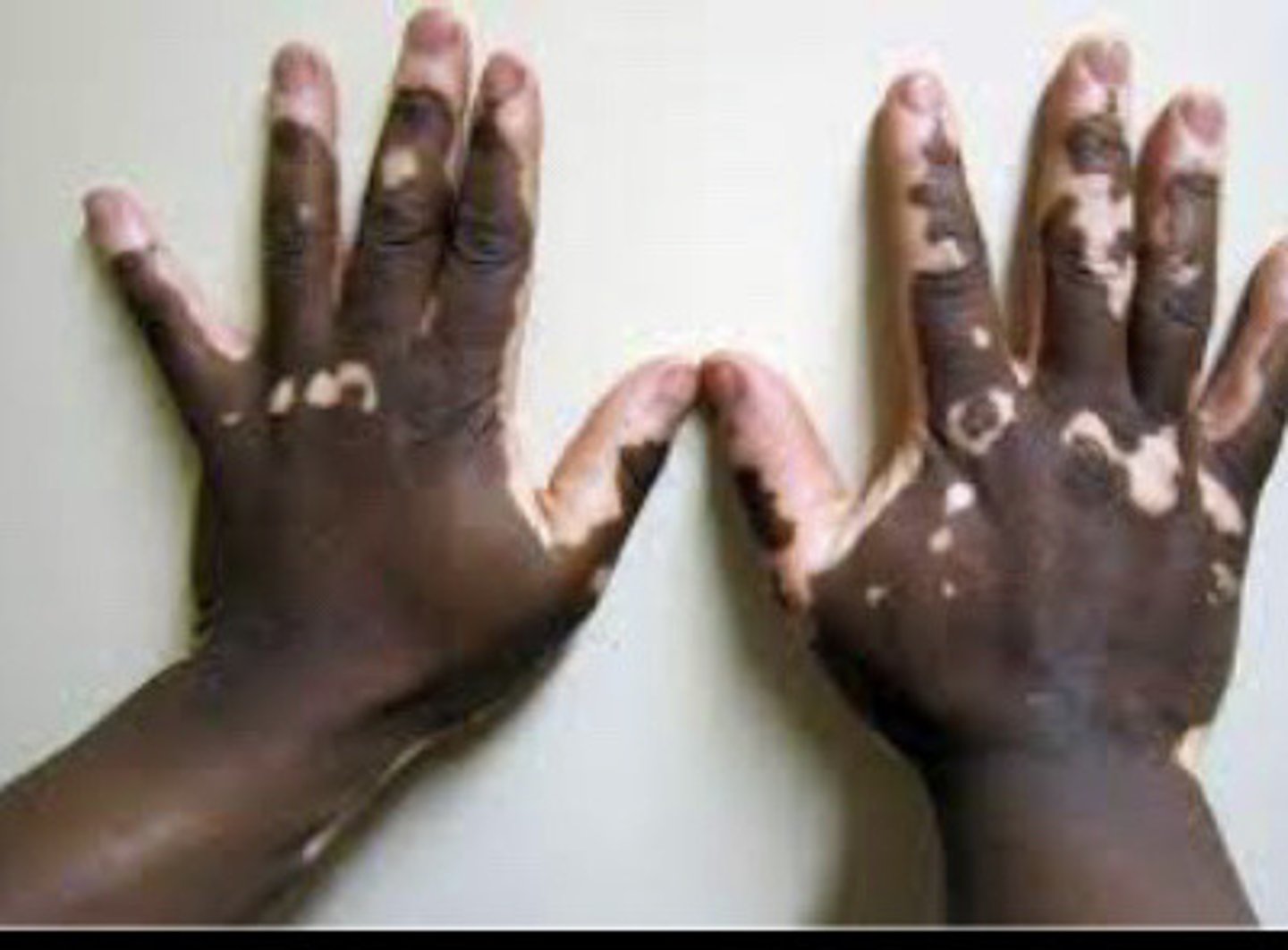 <p>Vitiligo</p>