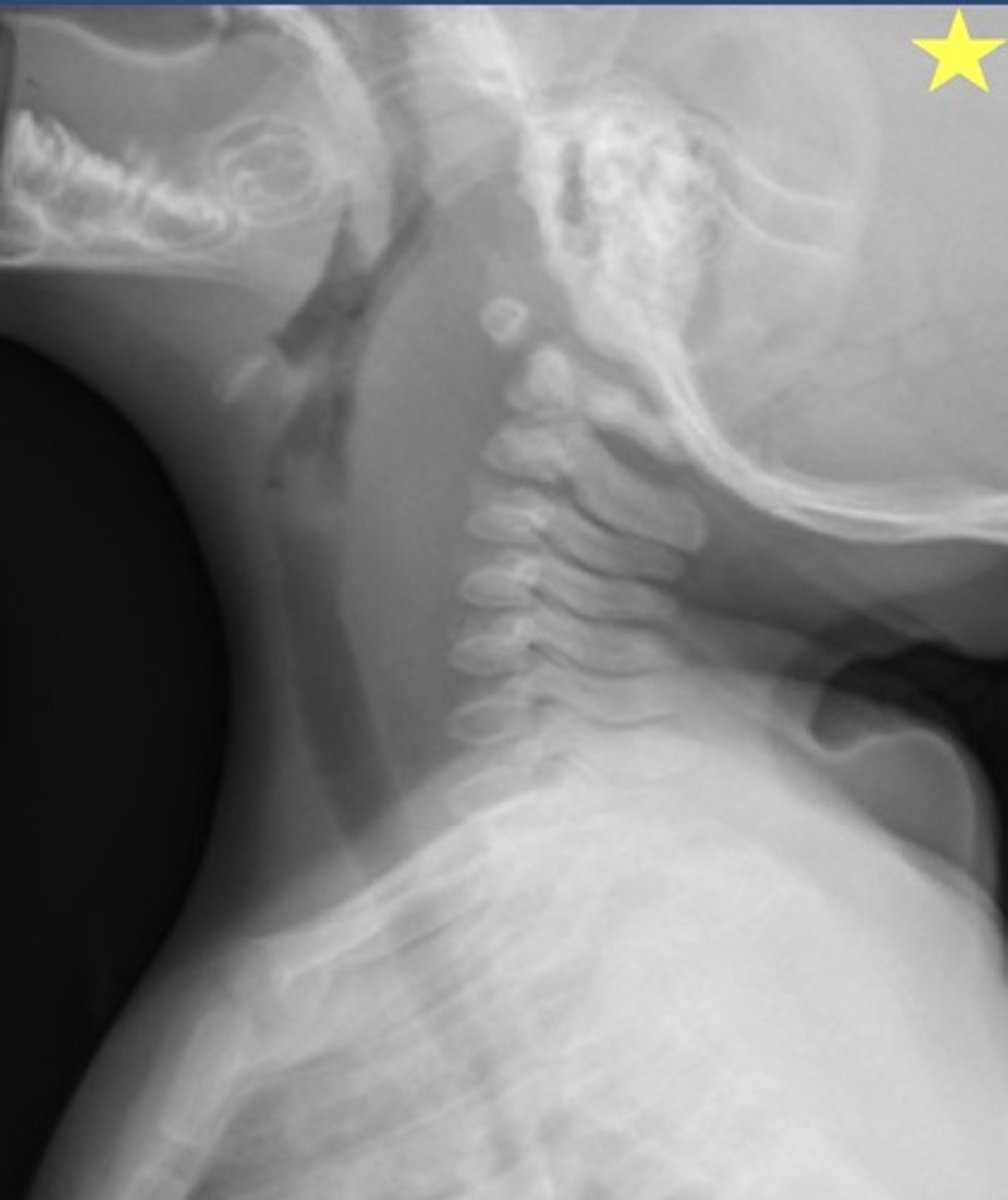 <p>Identify the radiographic abnormality.</p>