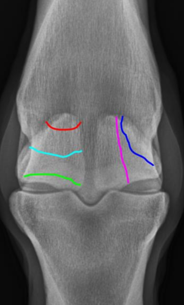 <p>sesamoid fx’s</p>