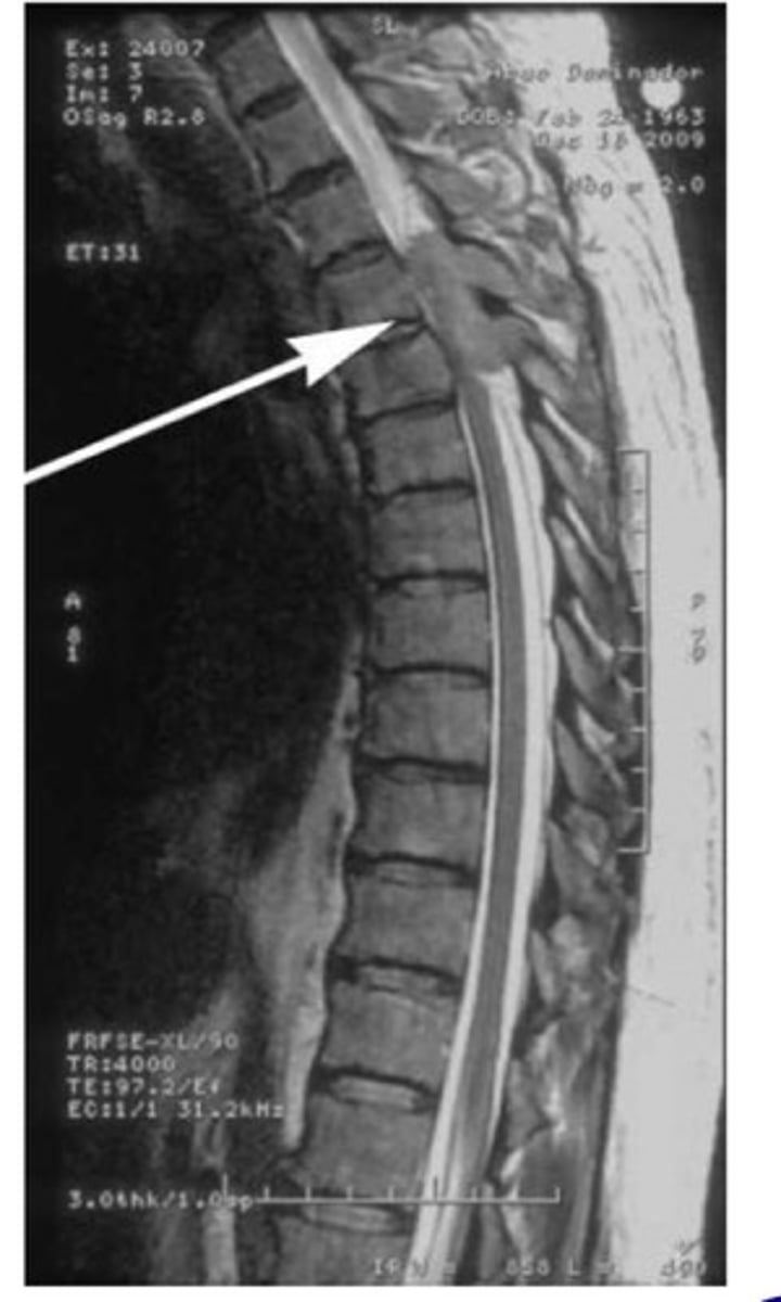 <p>MRI w/ gadolinium contrast</p>
