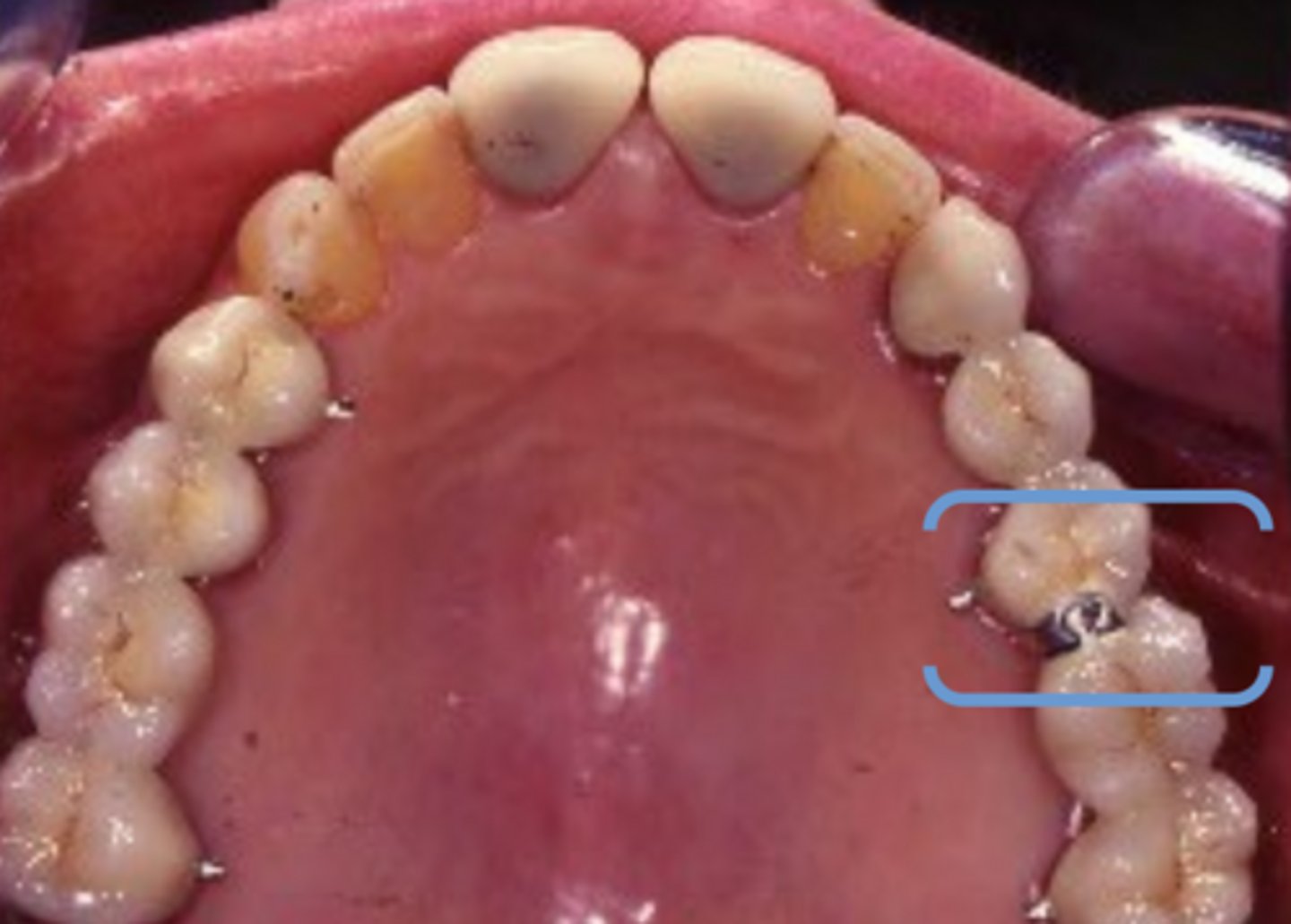 <p>What is indicated in the blue brackets?</p>
