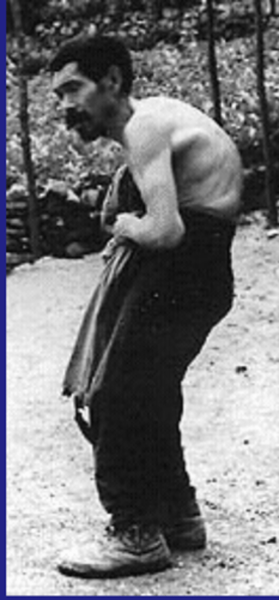 <p>Skeletal fluorosis</p>