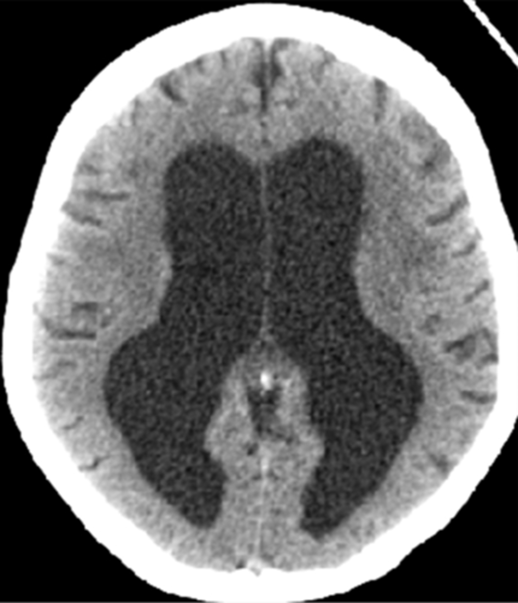 <p>1) Gait instability</p><p>2) Urinary incontinence</p><p>3) Dementia</p><p>Hydrocephalus w/ minimal cortical atrophy (fluid buildup out of proportion to atrophy)</p>