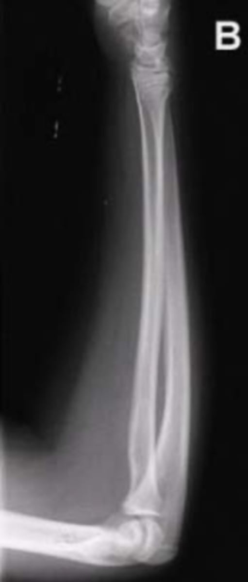 <p>ulnar head at wrist<br>radial head at elbow</p>