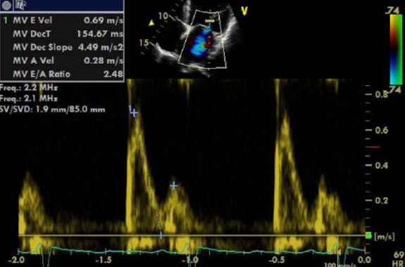 <p><span>In early stages of restrictive cardiomyopathy, this would be a common E/A ratio.&nbsp;</span></p>