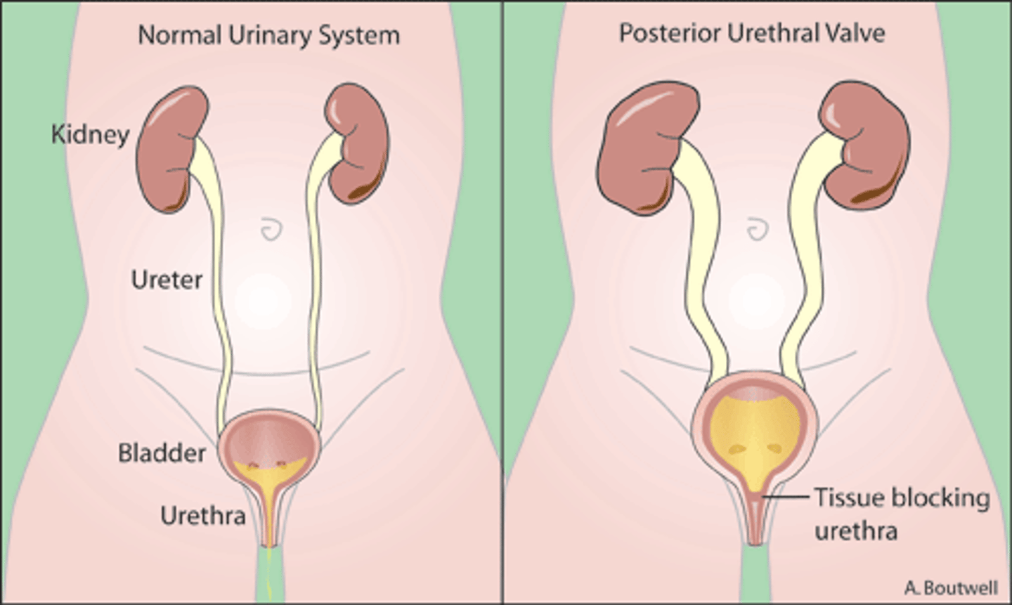 <p>Posterior urethral valves</p>