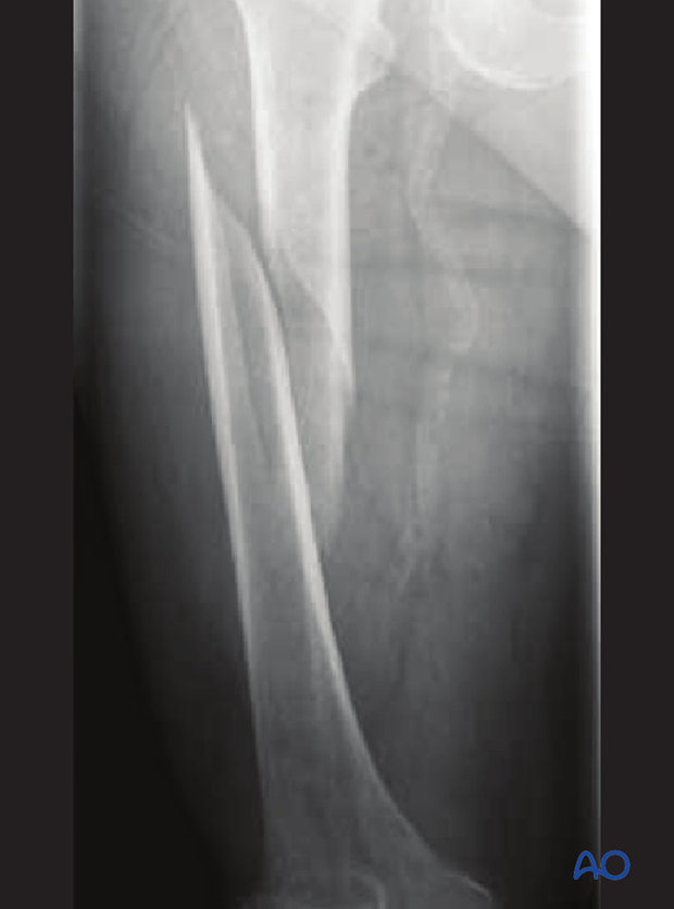 <p>The break coils around the bone - common in femur fractures</p>