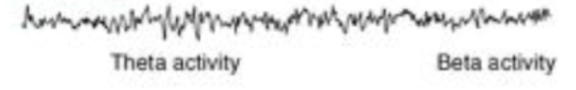 <p>what sleep stage is this EEG recording?</p>