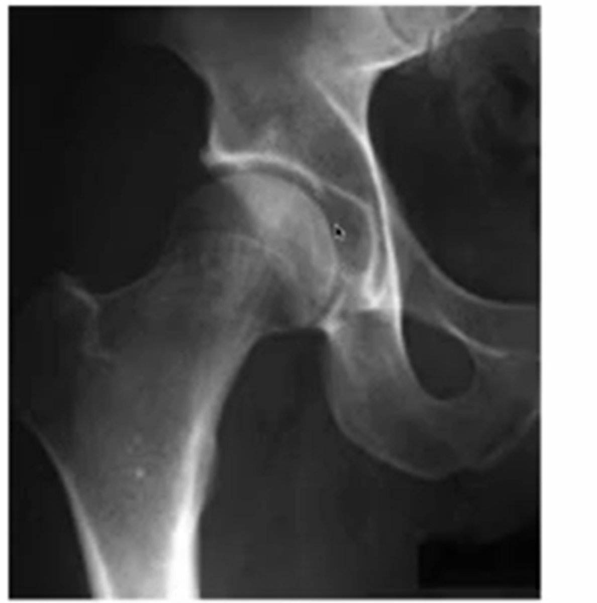 <p>the whiter parts of the acetabulum</p><p>(because of WB)</p>