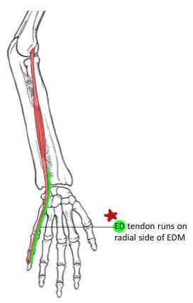 <p>Extensor Digiti Minimi</p>