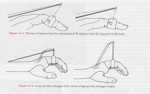 <p>-Good for long term attempts to fix contractures, increase ROM<br>-90 degree line of pull for even distribution of pressure</p>