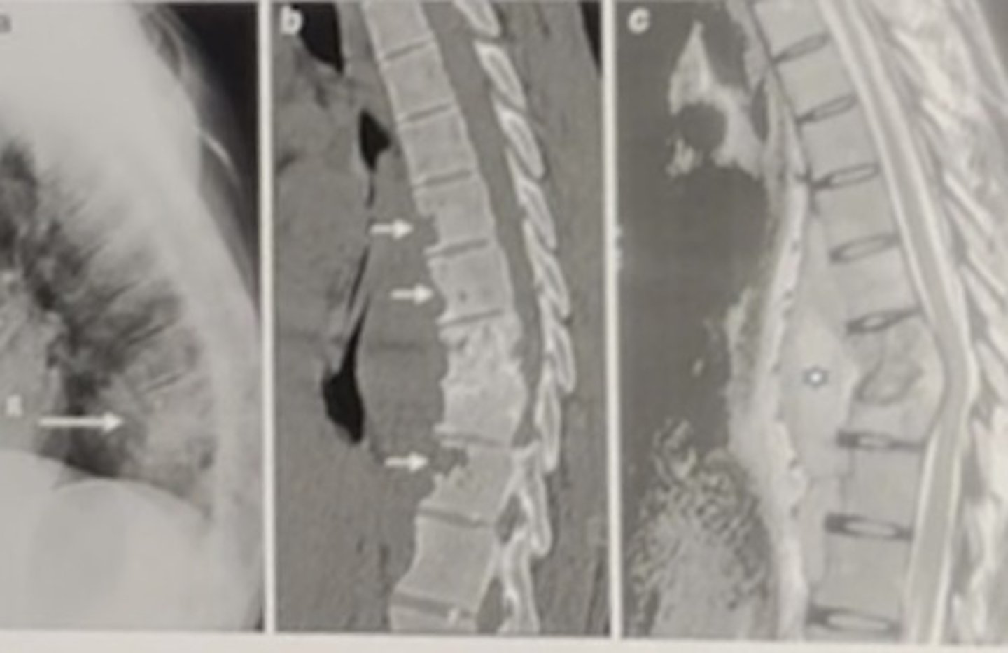 <p>tuberculosis spondylitis</p><p>3 multiple choice options</p>