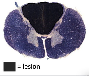 <p>a lesion in the black area would cause what type of lesion?</p>